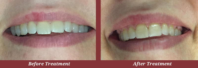 Before & After Veneers in Carlisle