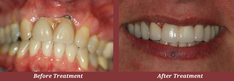 Before & After Dental Implants in Carlisle