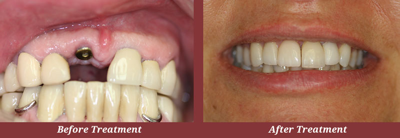 Before & After Dental Implants in Carlisle