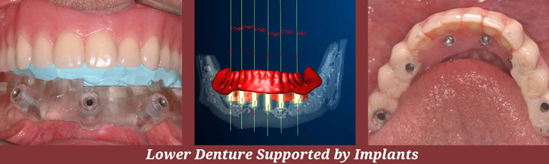 Guided Implant Placement in Carlisle