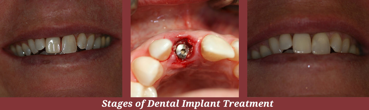 Stages of Dental Implants in Carlisle