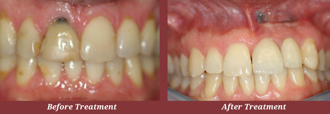 Before & After Dental Implants in Carlisle