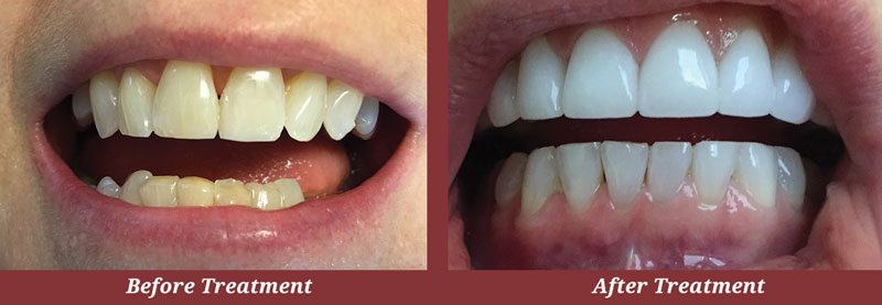 Before & After Teeth Whitening in Carlisle