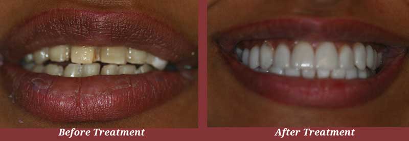 Before & After Veneers in Carlisle, MA