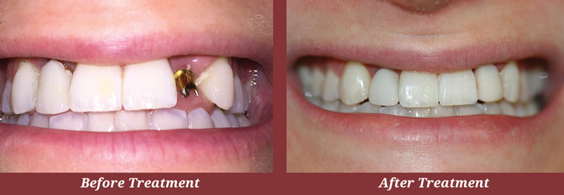 Before & After Dental Implants in Carlisle, MA