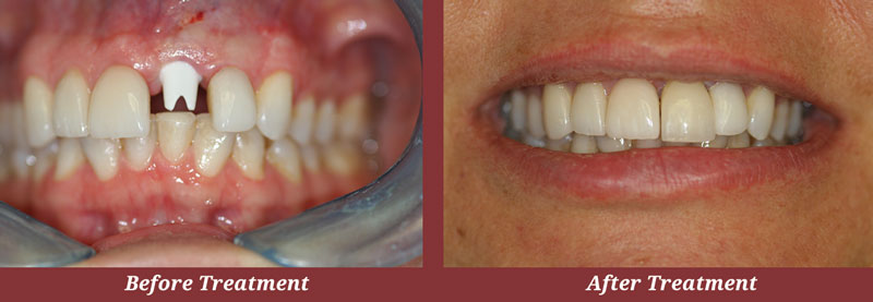 Before & After Implants in Carlisle
