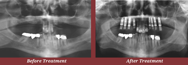 Guided Implant Placement X-rays