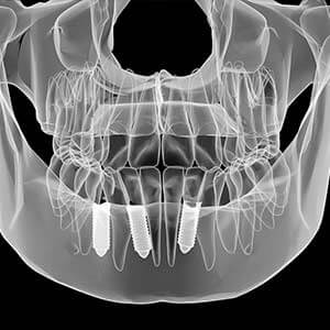 Dental Implants X-Ray