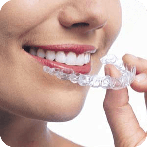 Invisalign Appliance